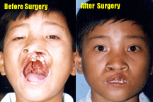 Cleft-Palate / Lip Surgery Program