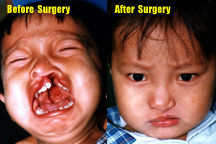 Cleft-Palate / Lip Surgery Program