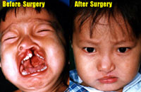 Cleft-Palate / Lip Surgery